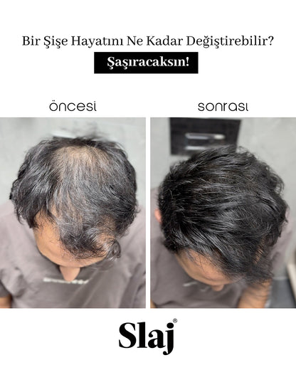 Saç Kapatıcı 10-15 Gün Kalıcı