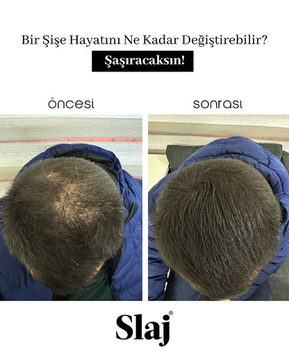 Saç Kapatıcı 10-15 Gün Kalıcı