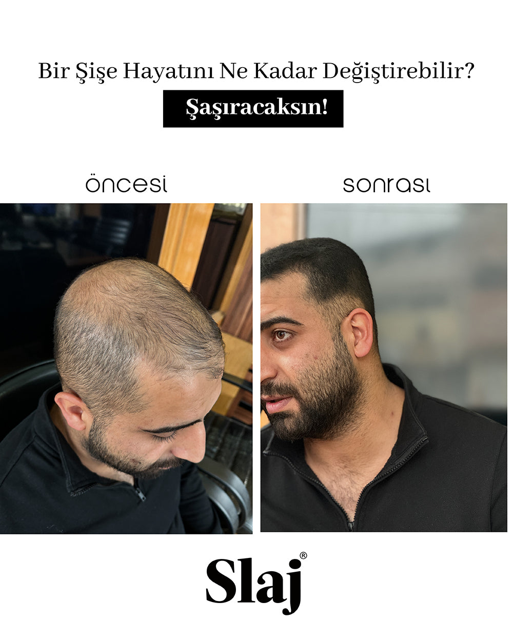 Saç Kapatıcı 10-15 Gün Kalıcı