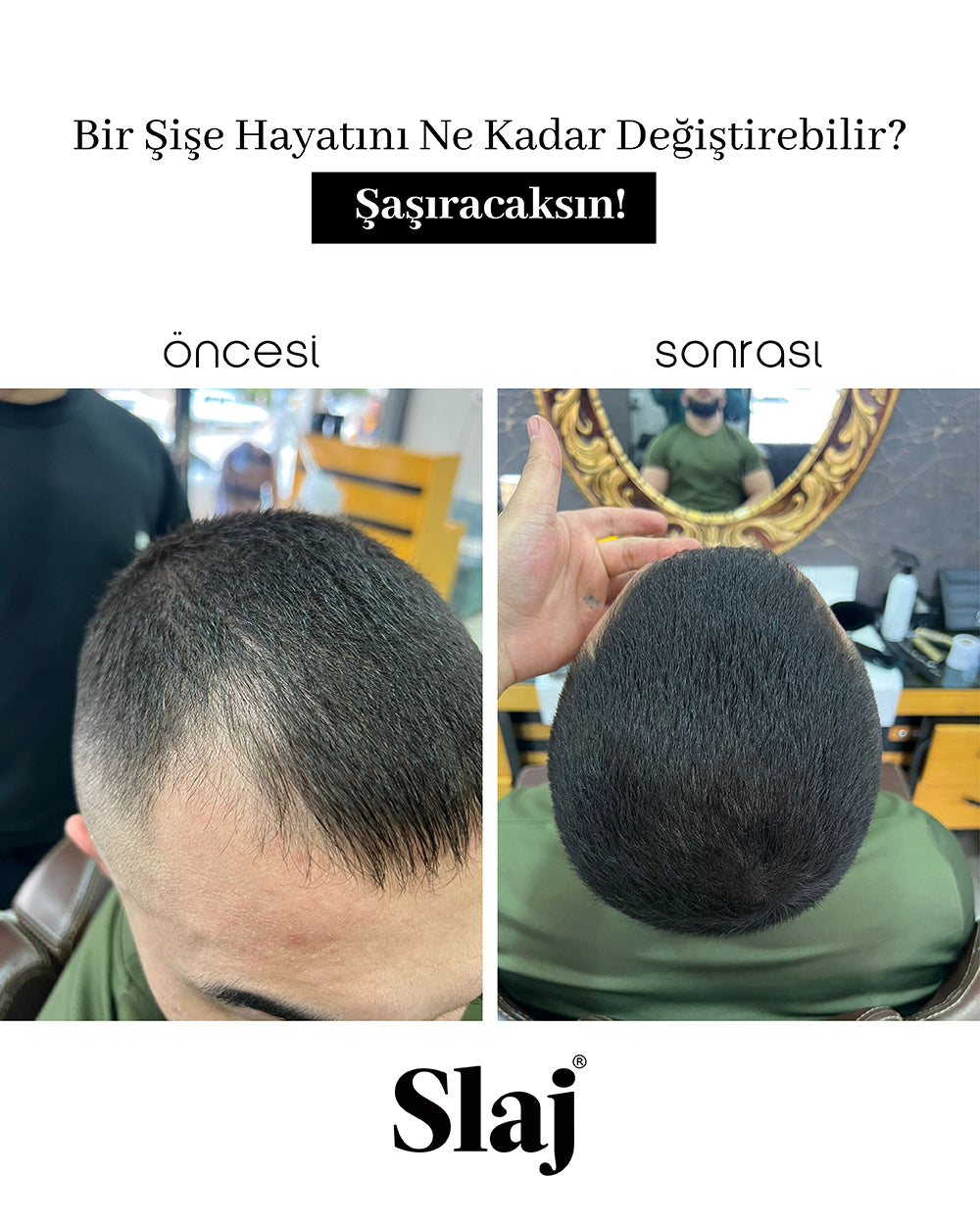 Saç Kapatıcı 10-15 Gün Kalıcı